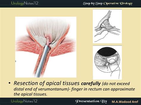 TURP step by step operative urology