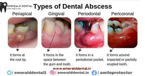 TYPES OF DENTAL ABSCESS - EMERALD DENTAL