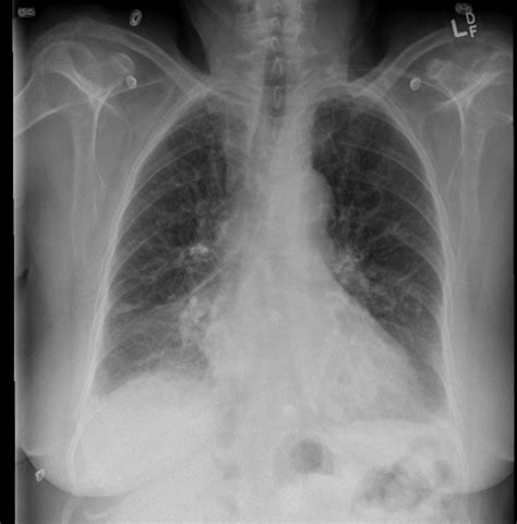 Congestive Heart Failure – Undergraduate Diagnostic Imaging Fundamentals