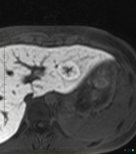 Focal nodular hyperplasia | Image | Radiopaedia.org