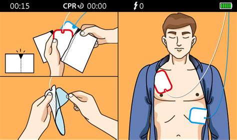 AED Use: What Are Recommended Steps to Use an AED? - Mindray