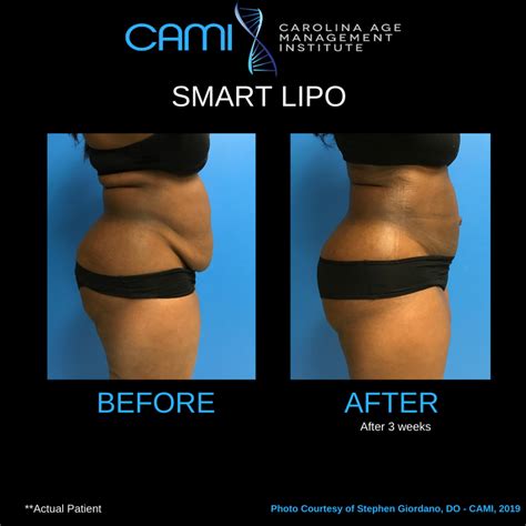 Smartlipo Before and After, Smart Liposuction Before and After Photos