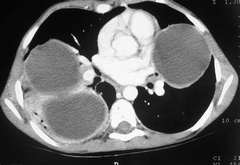 Multiple Hydatid Cysts of the Lung - Manual of Medicine