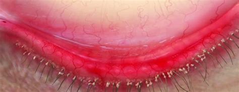 Educating Patients on Demodex Blepharitis - Rendia