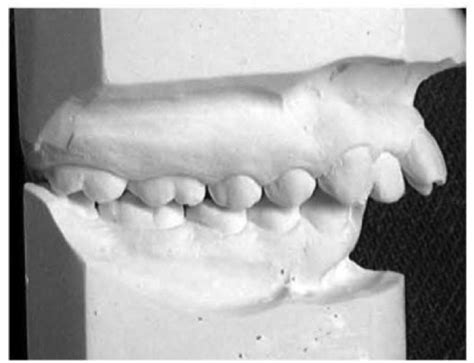 Functional Occlusion in the Dental Lab: Understanding the 3 Classes of Occlusion