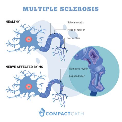 Bladder Management with Multiple Sclerosis - CompactCath