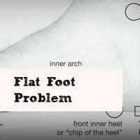 What Is Flat Foot And Its Treatment