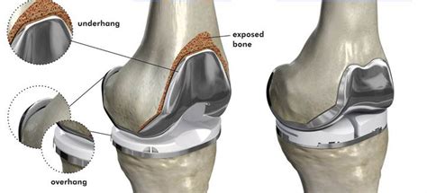 Total Knee Joint Replacement Surgery, Arthritis Treatment in India