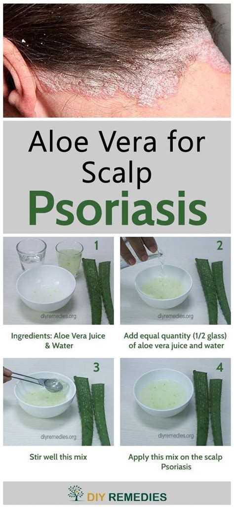 Aloe Vera for Scalp Psoriasis Scalp psoriasis can be appeared as raised ...