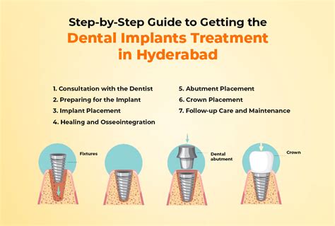 Step By Step Guide to the Dental Implant Procedure