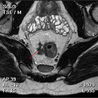 (PDF) Extramural venous invasion is a potential imaging predictive ...