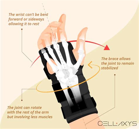 How To Manage Ulnar-Sided Wrist Pain With A Brace? - Cellaxys