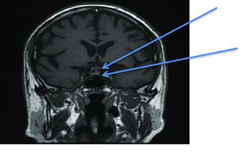 MRI with contrast. A coronal view of the pituitary gland 3 months after... | Download Scientific ...