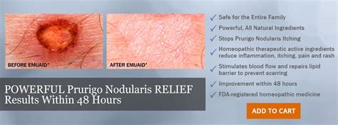 Prurigo Nodularis Solution | Treatment, Homeopathic medicine, Homeopathic