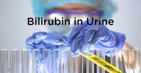 Bilirubin in urine – DoctorOnHealth