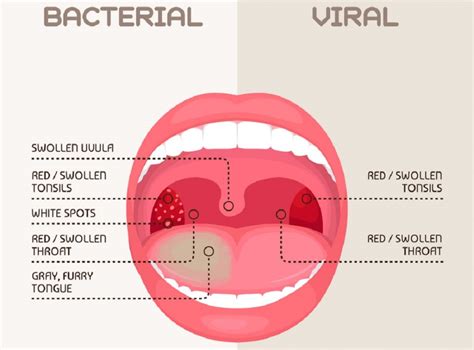 What Is Strep Throat