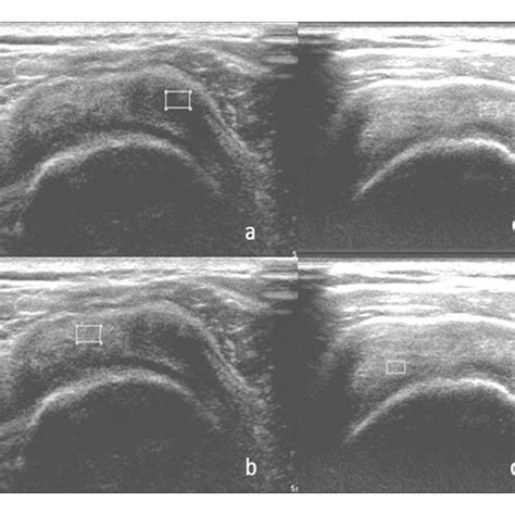 Echogenicity measurement of tendinosis (a) and normal tendon (b) at ...