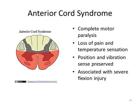 Anterior Cord Syndrome