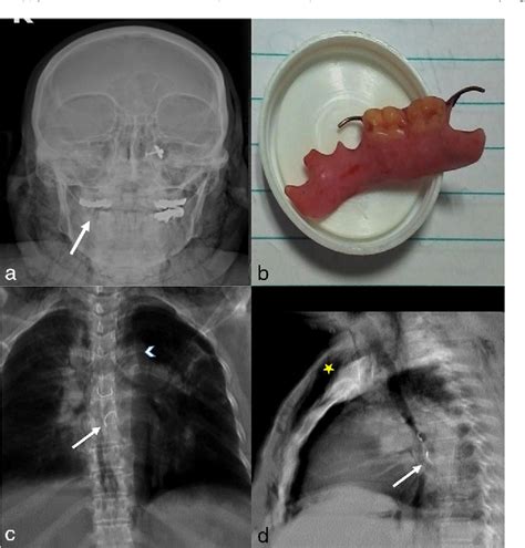 Esophageal tear | Semantic Scholar