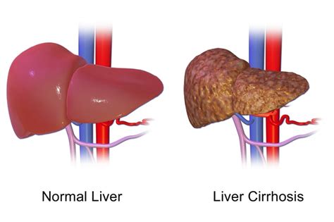 Sirosis Hepatis - patofisiologi, diagnosis, penatalaksanaan - Alomedika