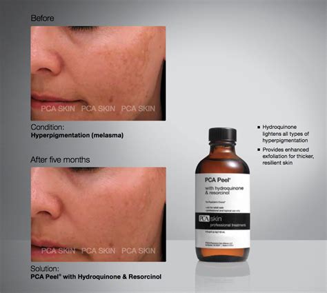 PCA Skin Peel Treatments — Sharon Gordon SKIN