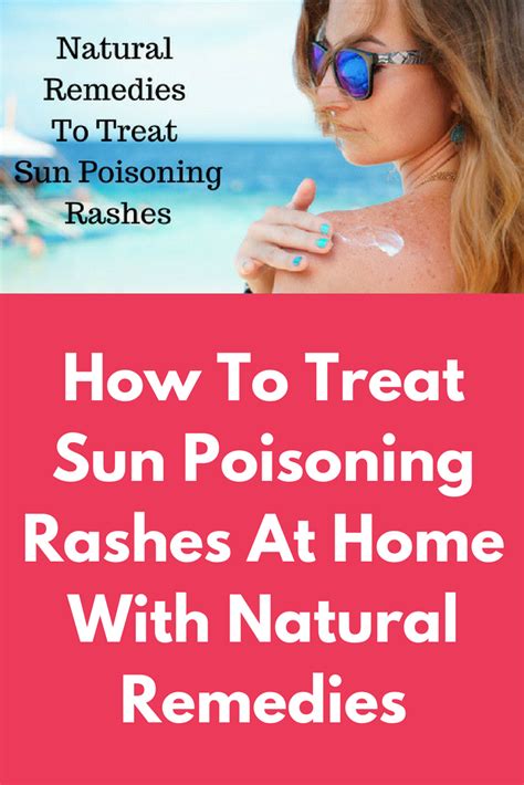 How To Treat Sun Poisoning Rashes At Home With Natural Remedies Sun ...