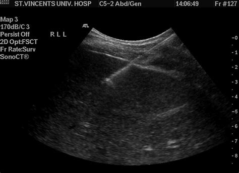 Image-guided Biopsy - Radiology at St. Vincent's University Hospital