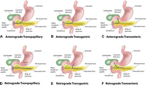 EUS-guided pancreatic drainage for pancreatic strictures after failed ERCP: a multicenter ...