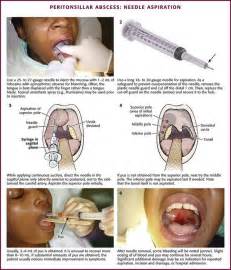 Otolaryngologic Procedures | Veterian Key