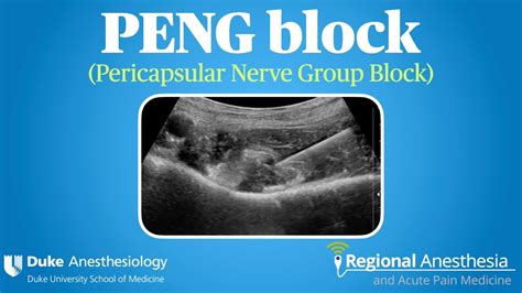 PENG Block (Pericapsular Nerve Group Block) - YouTube