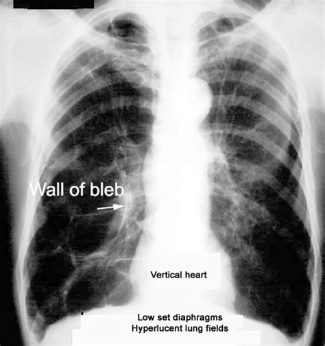 Low set diaphragm Flat diaphragm best determined by lateral chest Hyper lucent lung fields ...