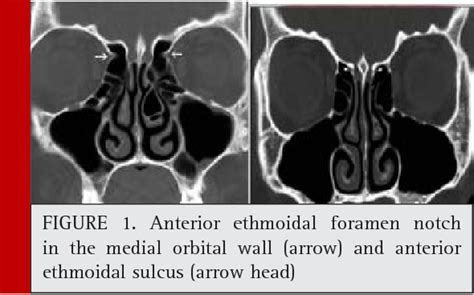 Figure 1 from Assessment of location of anterior ethmoidal artery using cone beam computed ...