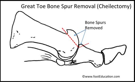 Great Toe Cheilectomy - FootEducation