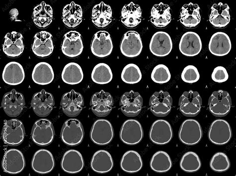 CT Scan Brain a male 38 year old.Finding Fracture frontal bone with ...