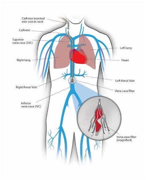 Inferior Vena Cava Filters | Center for Vein Care