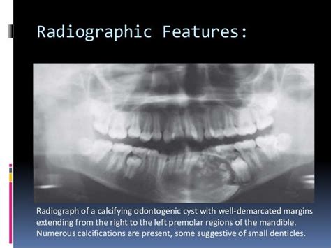 Image result for calcifying odontogenic cyst | Oral pathology, Cysts, Pathology