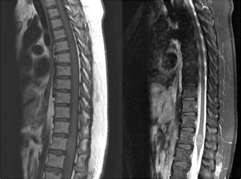 Thoracic Spine MRI. T1 MRI without gadolinium (left) and T1 MRI with... | Download Scientific ...