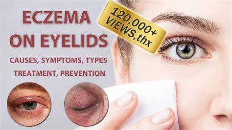 Eczema on Eyelids 2022 - 2023 | Causes, Symptoms, Types, Treatment and ...