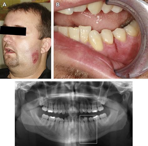 Orif Mandibular Fracture