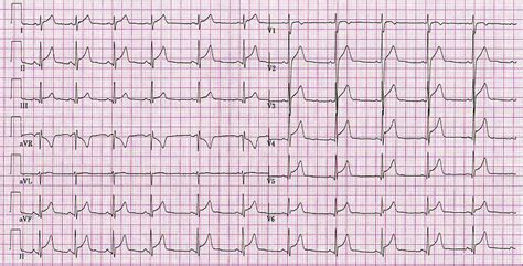 Myocarditis electrocardiogram | MTC Solutions