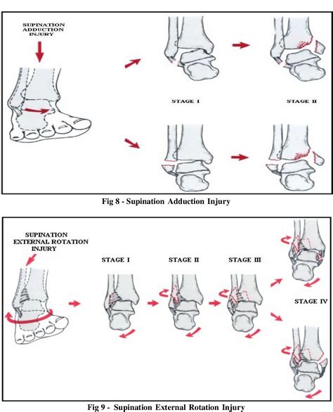 [PDF] Functional Outcome of Bimalleolar Ankle Fractures Treated With ...