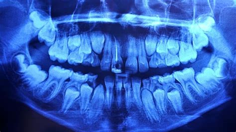 The Importance To Dental X-Rays | Preventative Dentistry Kauai HI