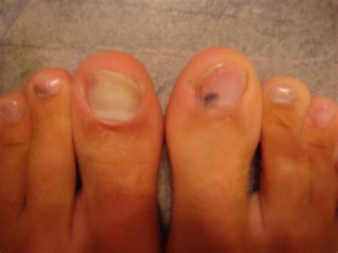 Black Spot On Toenail Near Cuticle - Nail Ftempo