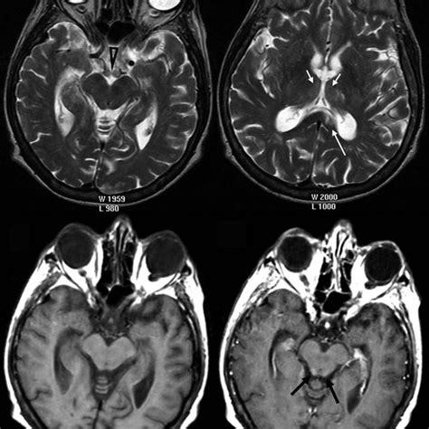 (PDF) CT and MRI of Wernicke's encephalopathy