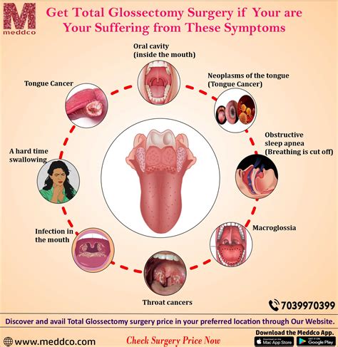 Total Glossectomy Surgery : Free Download, Borrow, and Streaming : Internet Archive