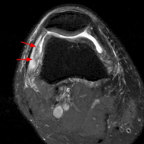 Synovial Plicae of the Knee | Radsource