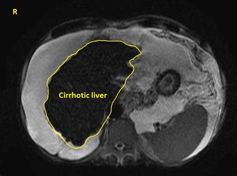 Cirrhosis MRI - wikidoc