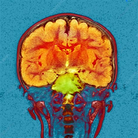 Brain cancer, MRI scan - Stock Image - M134/0595 - Science Photo Library