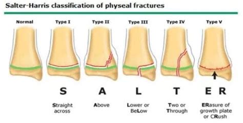 Salter Harris Fracture - Classification, Types 1 & 2, Treatment