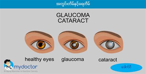 Cataract Vs Glaucoma – My Doctor